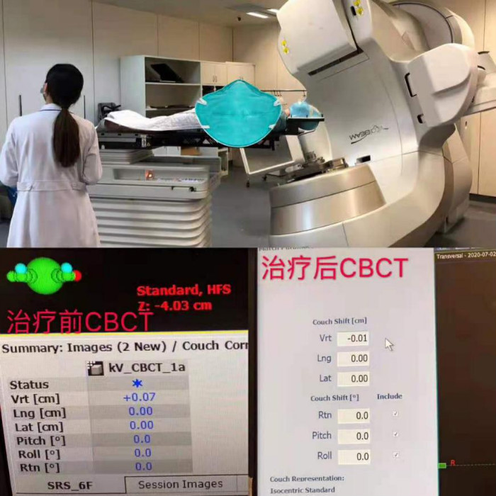CBCT，放疗定位